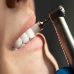 جرم گیری دندان