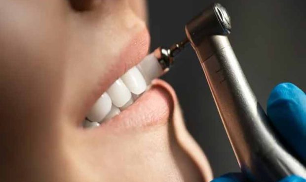 جرم گیری دندان چیست و چرا هر ۶ ماه یکبار باید انجام شود؟ جرم گیری دندان