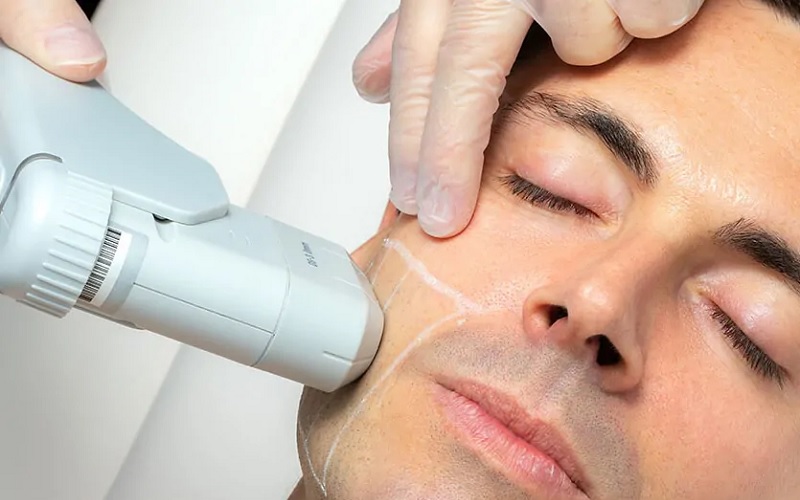هایفوتراپی صورت چیست و چگونه انجام میشود؟ قیمت هایفوتراپی در اصفهان