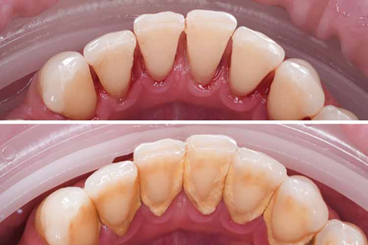 جرم گیری دندان چیست و چرا هر ۶ ماه یکبار باید انجام شود؟ رفع جرم دندان