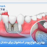 بهترین انواع پودر استخوان برای ایمپلنت دندان