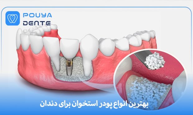 بهترین انواع پودر استخوان برای ایمپلنت دندان