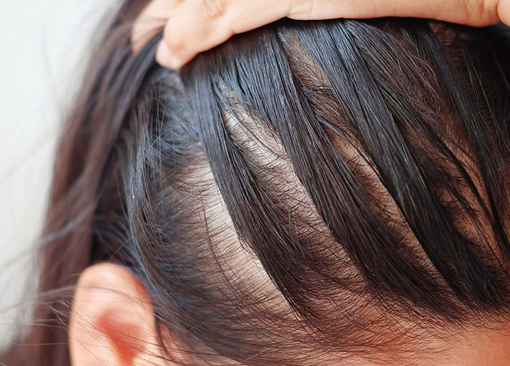 استفاده بیش از حد از ماسک مو و ریزش مو