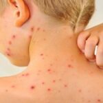 افزایش موارد ابتلا به سرخک در جهان با کاهش میزان واکسیناسیون افزایش موارد ابتلا به سرخک در جهان با کاهش میزان واکسیناسیون_69304ee2012cb.jpeg