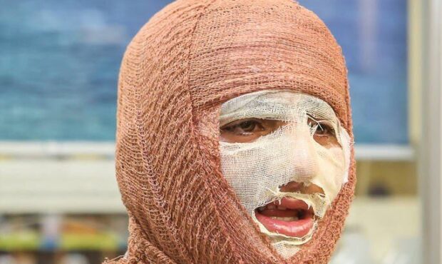 جلالی: سالانه حدود ۳۰۰ هزار نفر به مراکز سوختگی کشور مراجعه می‌کنند