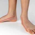 کف پای صاف چگونه باعث انحراف زانو می‌شود؟_6938443f9fbc2.jpeg