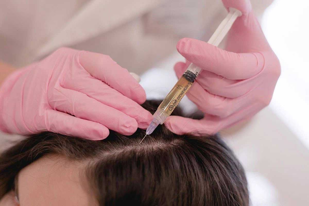 مزوتراپی مو