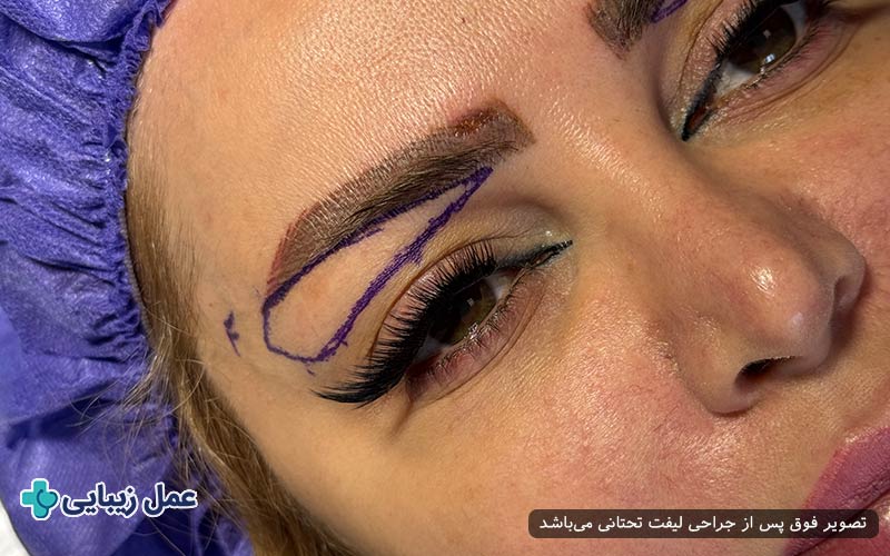 لیفت تحتانی ابرو