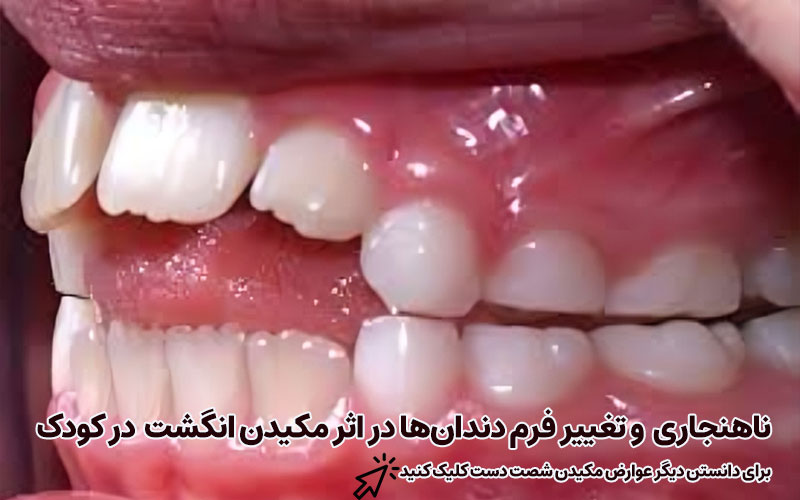روش‌های جلوگیری از کج شدن دندان بر اثر مکیدن انگشت و دیگر عوارض آن
