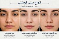 عمل بینی گوشتی؛ همه چیز درباره جراحی بینی با پوست ضخیم