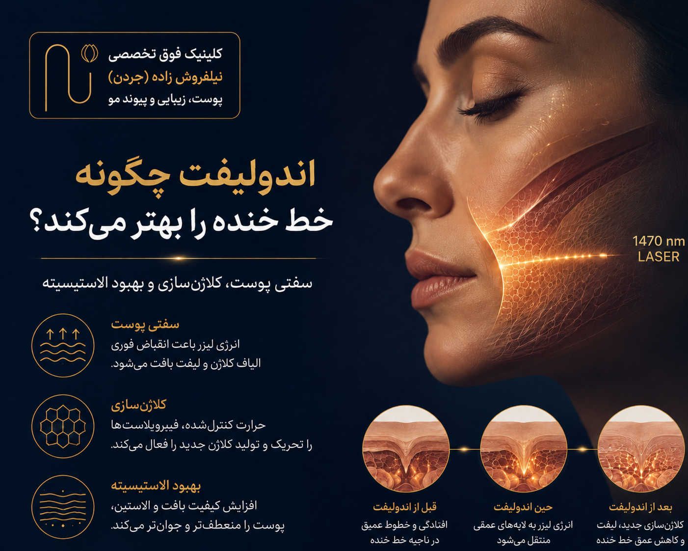 اندولیفت برای خط خنده موثر است؟ انجام اندولیفت
